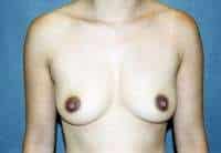 Breast Augmentation
