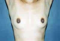 Breast Augmentation