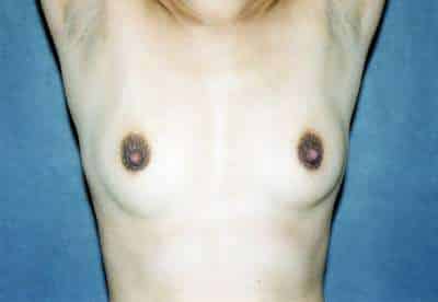 Breast Augmentation