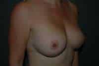 Breast Augmentation