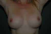 Breast Augmentation