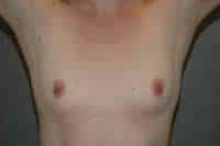 Breast Augmentation
