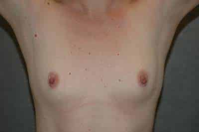 Breast Augmentation