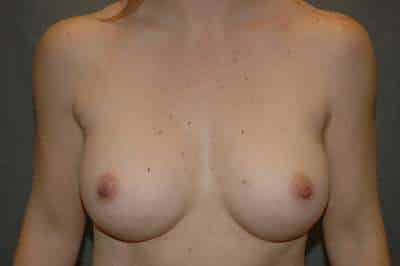 Breast Augmentation