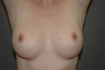 Breast Augmentation