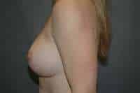 Breast Augmentation