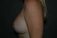 Breast Augmentation