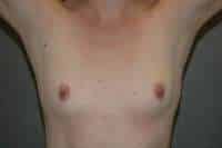 Breast Augmentation