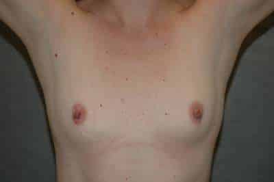 Breast Augmentation