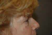 Eyelid Lift