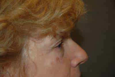 Eyelid Lift