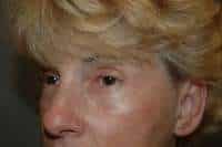 Eyelid Lift