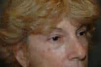 Eyelid Lift