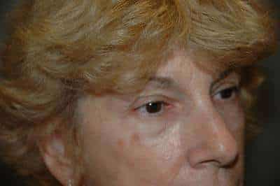 Eyelid Lift