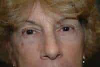 Eyelid Lift