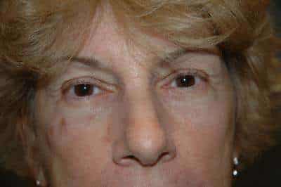 Eyelid Lift
