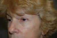 Eyelid Lift