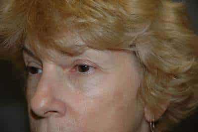 Eyelid Lift