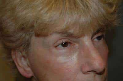 Eyelid Lift