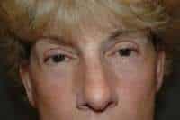 Eyelid Lift