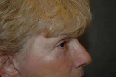 Eyelid Lift