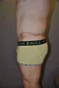 Male Belt Lipectomy