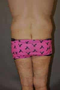Male Belt Lipectomy