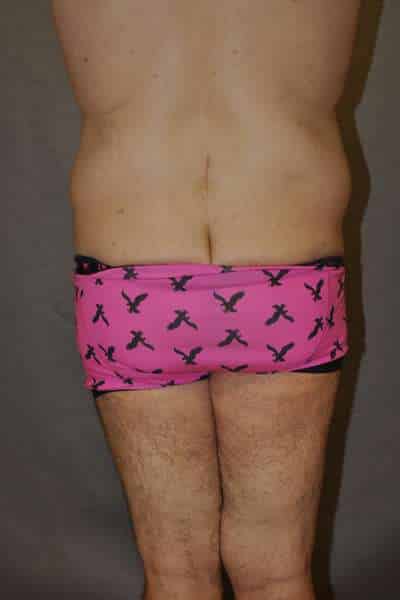 Male Belt Lipectomy