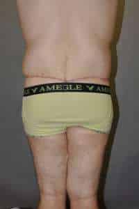 Male Belt Lipectomy