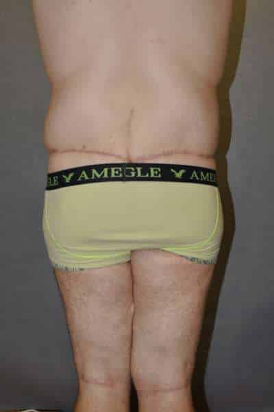 Male Belt Lipectomy