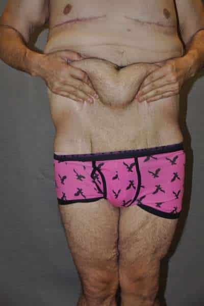 Male Belt Lipectomy