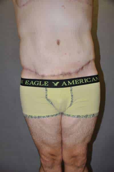 Male Belt Lipectomy
