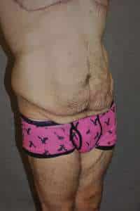 Male Belt Lipectomy