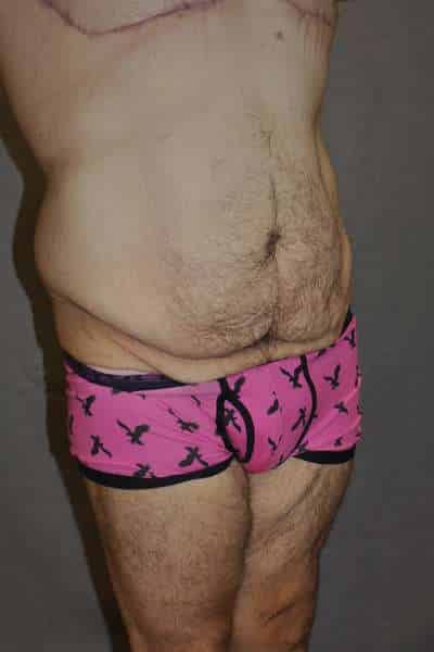 Male Belt Lipectomy