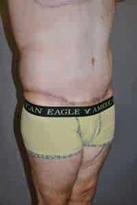 Male Belt Lipectomy