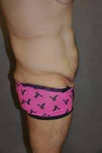Male Belt Lipectomy