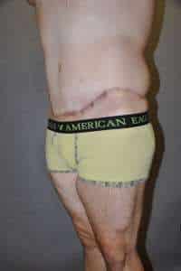 Male Belt Lipectomy