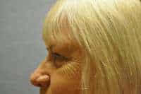 Eyelid Lift