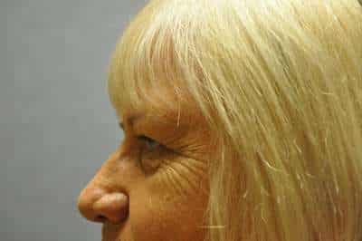 Eyelid Lift