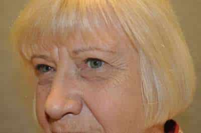 Eyelid Lift