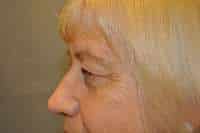Eyelid Lift