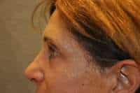Eyelid Lift