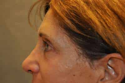 Eyelid Lift