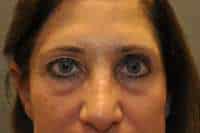 Eyelid Lift