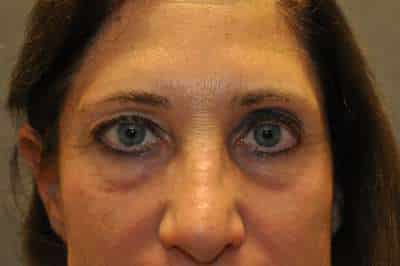 Eyelid Lift