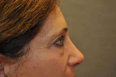Eyelid Lift