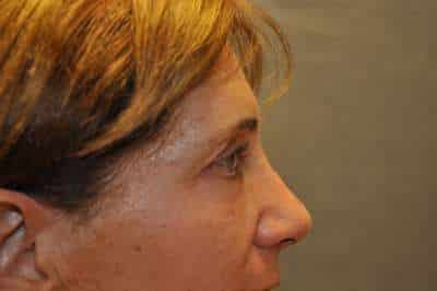 Eyelid Lift