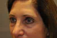 Eyelid Lift