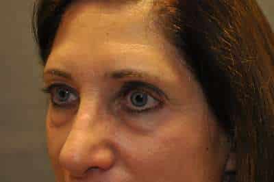 Eyelid Lift