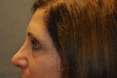 Eyelid Lift